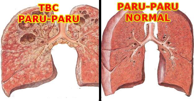 Hasil gambar untuk TBC