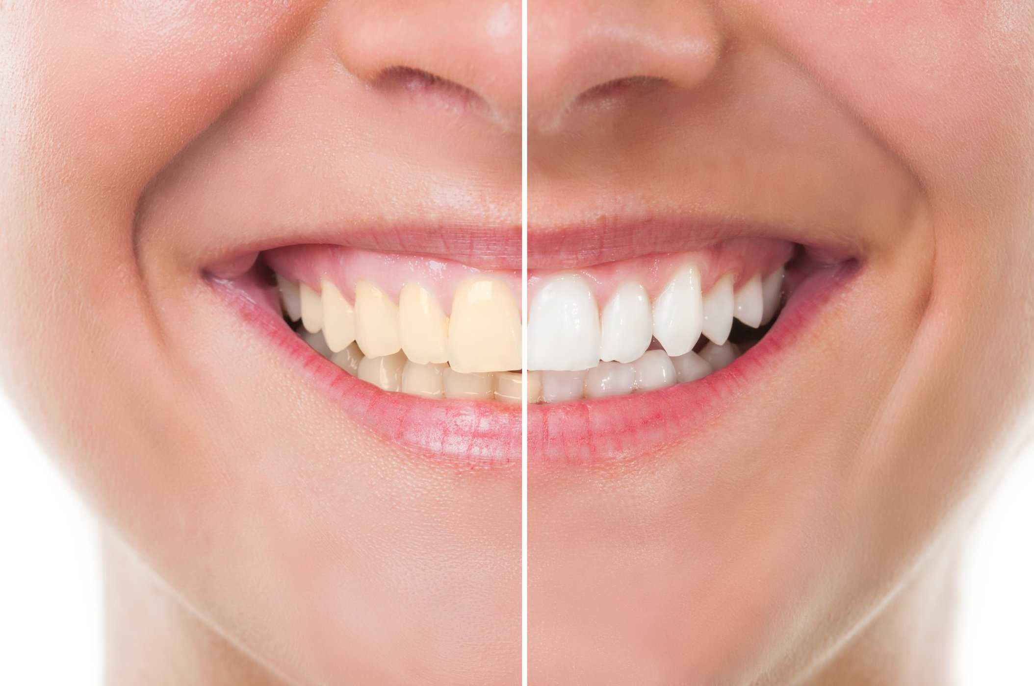 Tak Perlu Bleaching Untuk Gigi Putih, Cukup Konsumsi Makanan Ini Secara Rutin